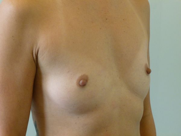 before breast augmentation right angle view female patient case 3341