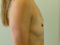 before breast augmentation right side view female patient case 3341