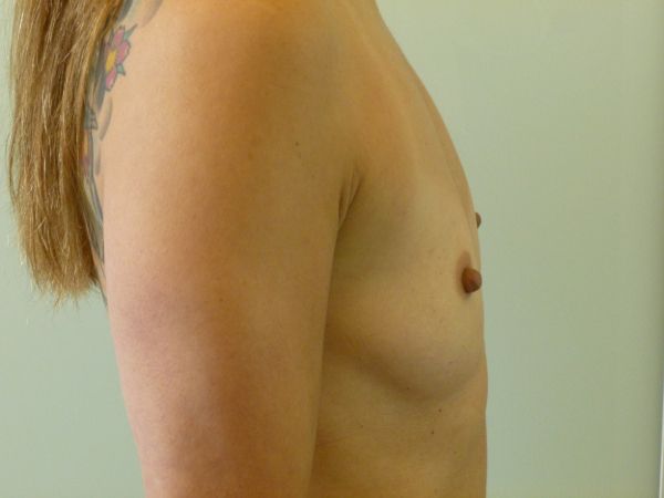 before breast augmentation right side view female patient case 3341