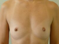 before breast augmentation front view female patient case 3341