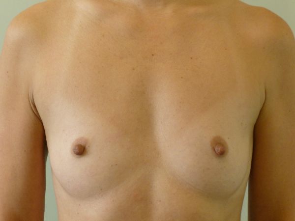 before breast augmentation front view female patient case 3341