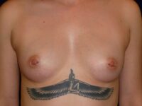 before breast augmentation front view female patient case 3352