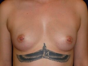 before breast augmentation front view female patient case 3352