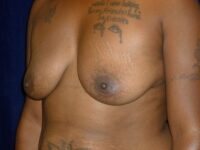 before breast augmentation left angle view female patient case 3363