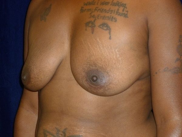 before breast augmentation left angle view female patient case 3363