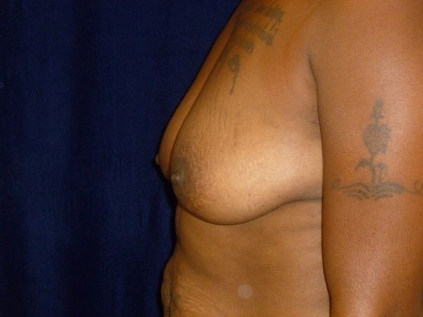 before breast augmentation left side view female patient case 3363