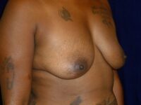 before breast augmentation right angle view female patient case 3363