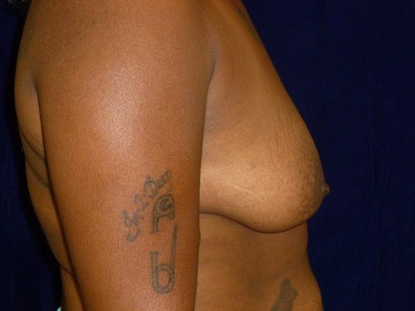 before breast augmentation right side view female patient case 3363