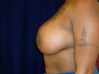 after breast augmentation left side view female patient case 3363
