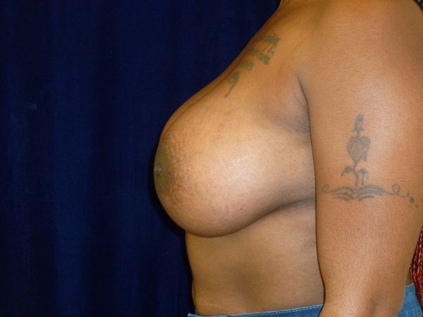 after breast augmentation left side view female patient case 3363
