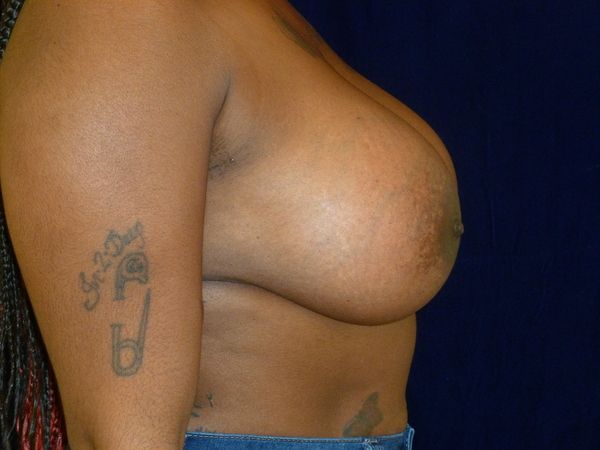 after breast augmentation right side view female patient case 3363
