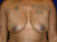 before breast augmentation front view female patient case 3363