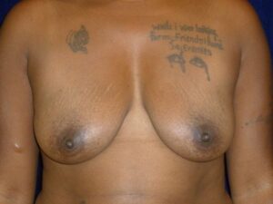 before breast augmentation front view female patient case 3363