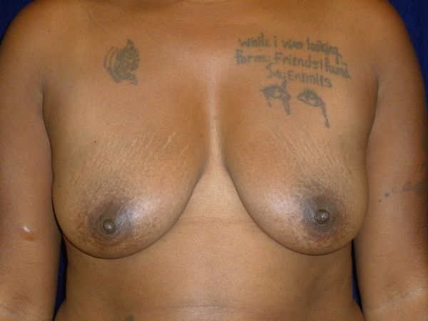 before breast augmentation front view female patient case 3363
