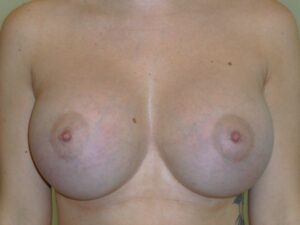 after breast augmentation front view female patient case 3421