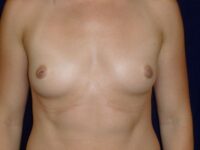before breast augmentation front view female patient case 3432