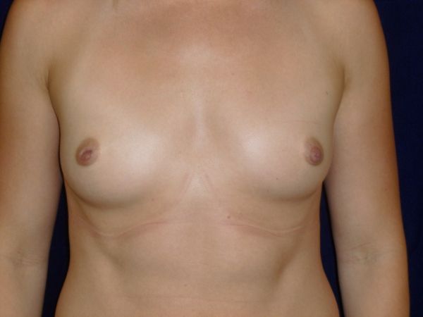 before breast augmentation front view female patient case 3432