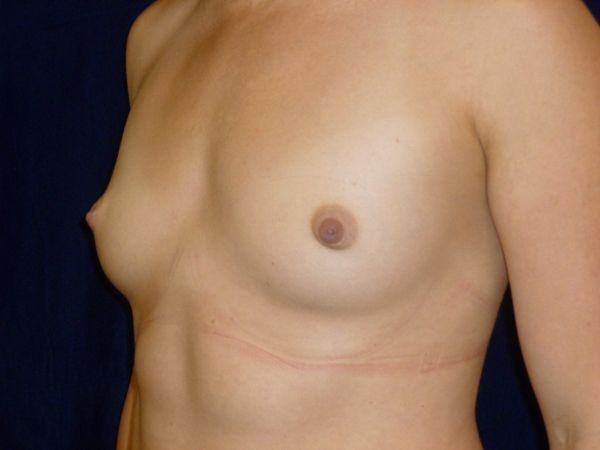 before breast augmentation left angle view female patient case 3432
