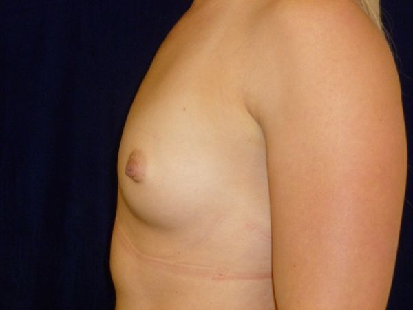 before breast augmentation left view female patient case 3432