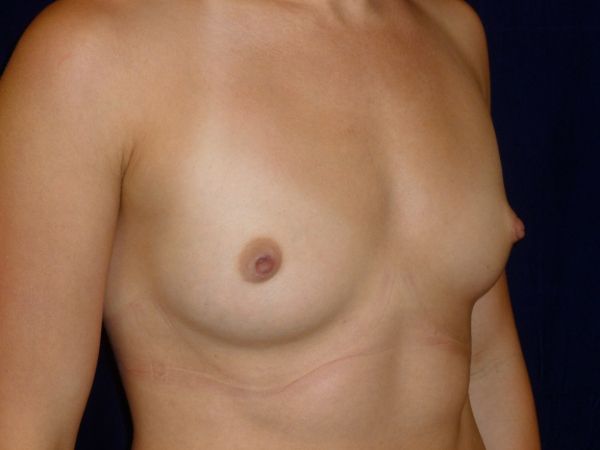 before breast augmentation right angle view female patient case 3432