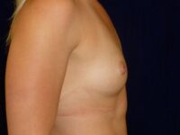 before breast augmentation right view female patient case 3432