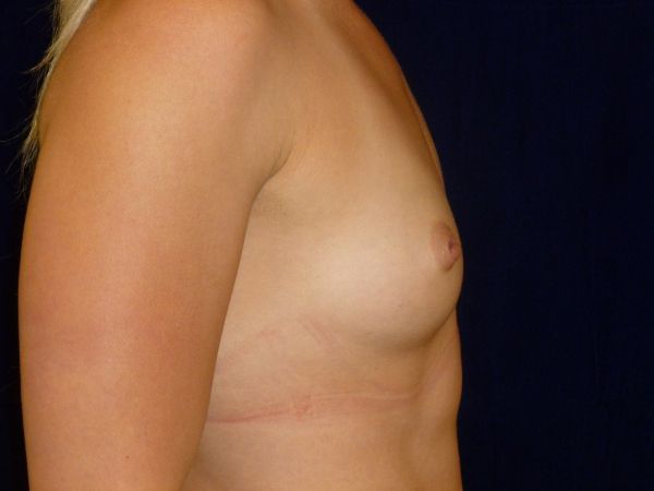 before breast augmentation right view female patient case 3432