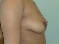 before breast augmentation right view female patient case 3443