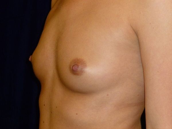 before breast augmentation left angle view female patient case 3454