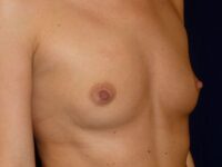 before breast augmentation right angle view female patient case 3454