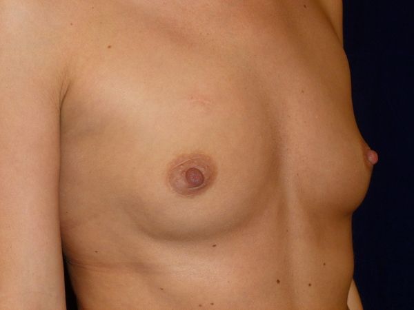 before breast augmentation right angle view female patient case 3454