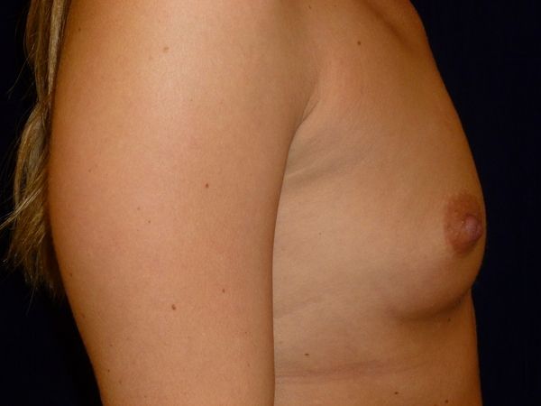 before breast augmentation right view female patient case 3454