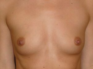 before breast augmentation front view female patient case 3454