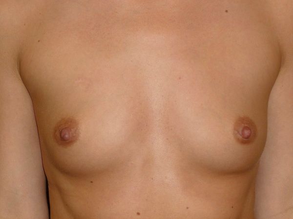before breast augmentation front view female patient case 3454