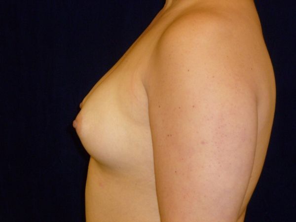 before breast augmentation left view female patient case 3465