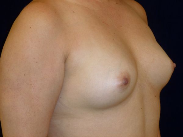 before breast augmentation right angle view female patient case 3465