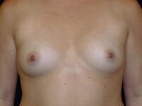 before breast augmentation front view female patient case 3465