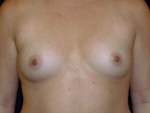 before breast augmentation front view female patient case 3465