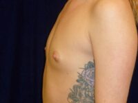 before breast augmentation left view female patient case 3474