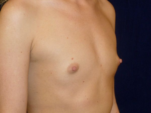 before breast augmentation right angle view female patient case 3474