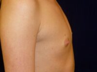 before breast augmentation right view female patient case 3474