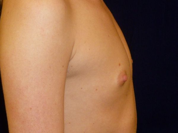 before breast augmentation right view female patient case 3474