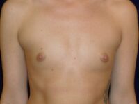 before breast augmentation front view female patient case 3474