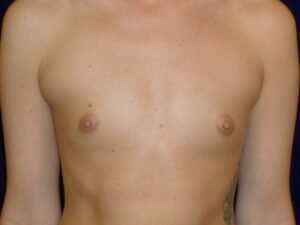 before breast augmentation front view female patient case 3474