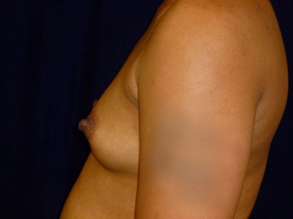 before breast augmentation left view female patient case 3485