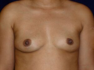 before breast augmentation front view female patient case 3485