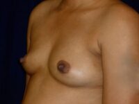 before breast augmentation left angle view female patient case 3485
