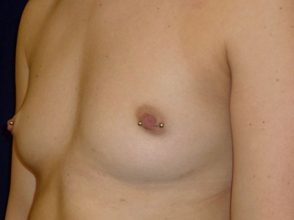 before breast augmentation left angle view female patient case 3492