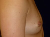 before breast augmentation right view female patient case 3492