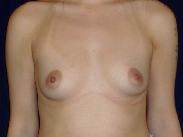 before breast augmentation front view female patient case 3503