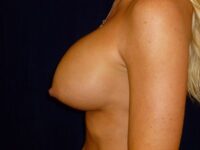 before breast augmentation revision left side view female patient case 3308